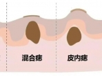  这种“痣”要警惕，可能是黑色素瘤！ 