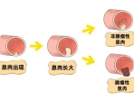 体检发现肠息肉，要切吗？