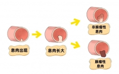 体检发现肠息肉，要切吗？