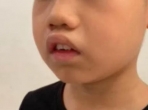 孩子越长越“丑”？警惕腺样体面容！让“儿童睡眠监测”来探其究竟！
