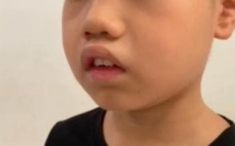 孩子越长越“丑”？警惕腺样体面容！让“儿童睡眠监测”来探其究竟！