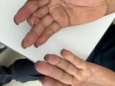 五院主诊 | 炎症性关节病组：指尖发紫发凉，检查时手指头已经坏死