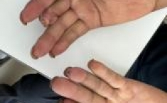 五院主诊 | 炎症性关节病组：指尖发紫发凉，检查时手指头已经坏死