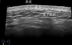 【五院科普】超高频皮肤超声：皮肤检查的 “隐形放大镜”