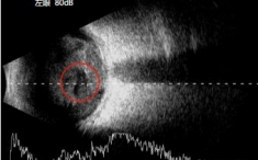 五院主诊 | 眼底病组：硬物弹伤左眼，眼球险些不保